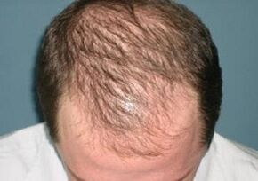 vzroki za izpadanje las