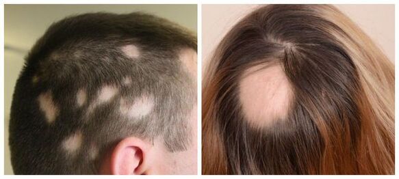 Alopecija areata