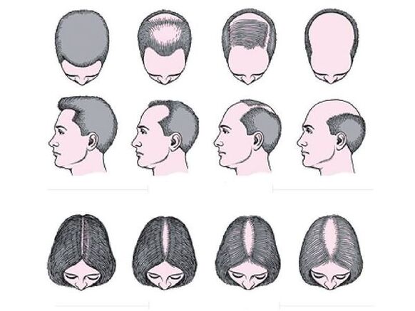 Androgena alopecija pri moških in ženskah