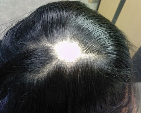 Alopecia areata ali alopecija areata pri ženskah