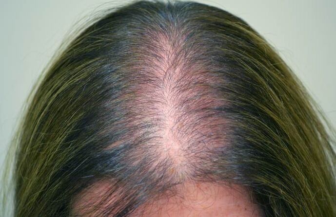 Alopecija (plešavost) pri ženskah