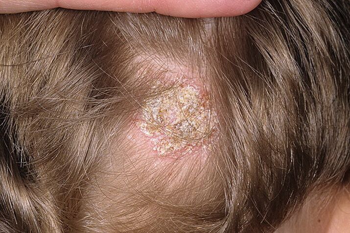 Seboroični tip alopecije pri ženskah