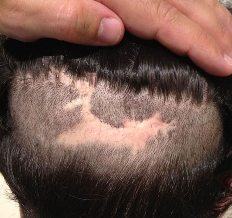 cicatricialna alopecija lasišča