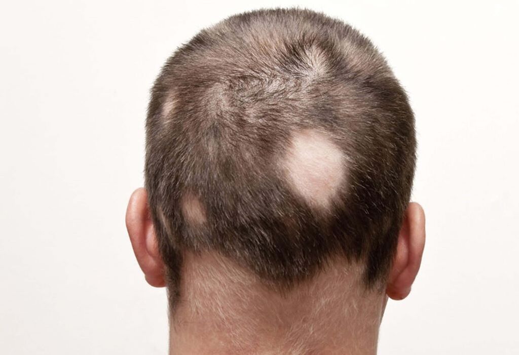gnezdeča (žariščna) alopecija glave