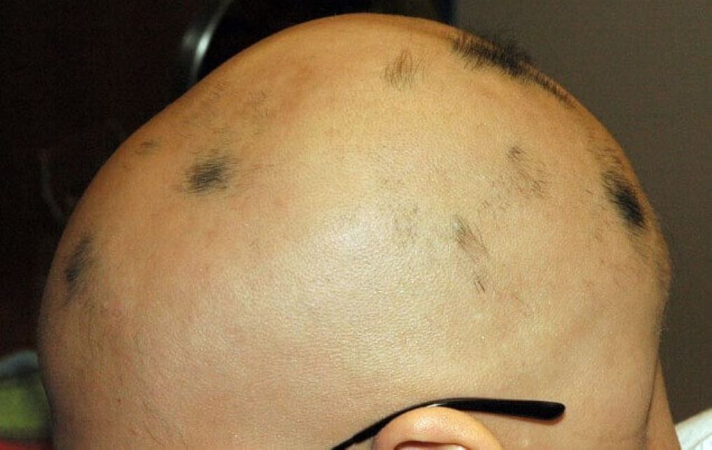 popolna alopecija lasišča pri moških