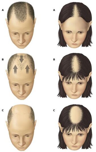 Androgena alopecija pri moških in ženskah
