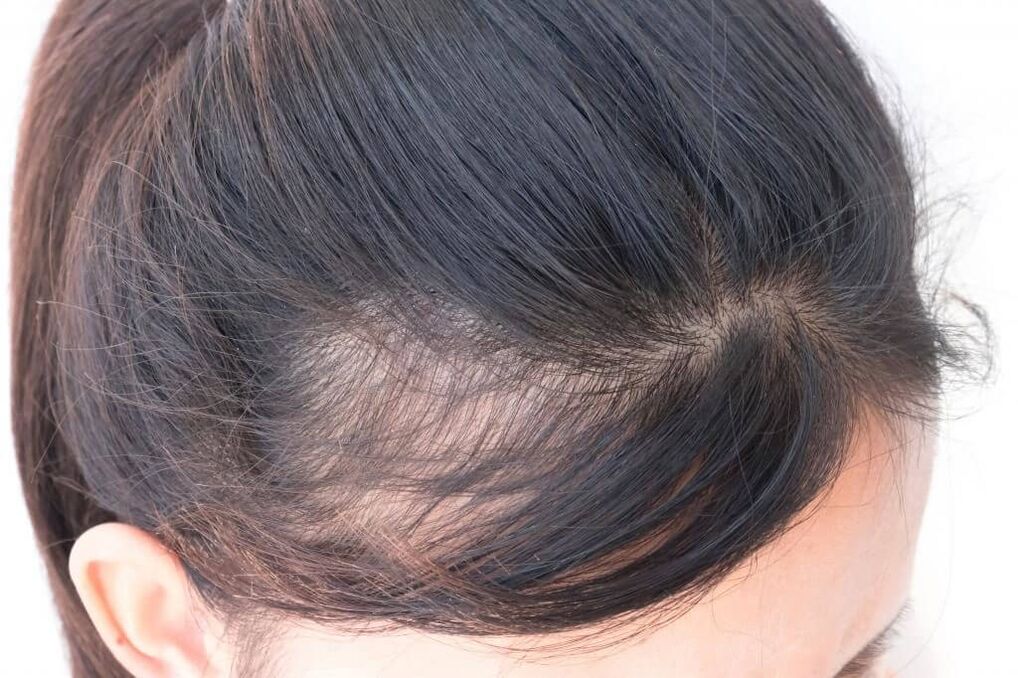 Androgena alopecija pri ženskah