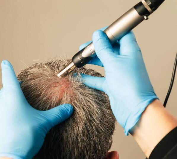 Fizioterapija za zdravljenje androgene alopecije