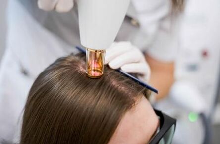 Lasersko zdravljenje androgene alopecije