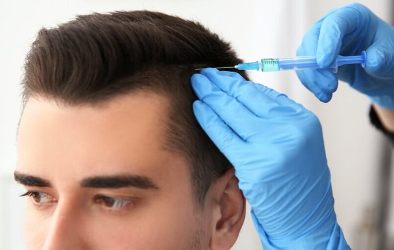 Mezoterapija za spodbujanje rasti las pri androgeni alopeciji
